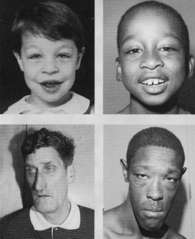 Facial characteristics of autism