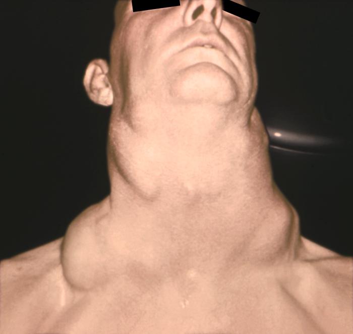 head and neck cancer thinglink head and neck cancer