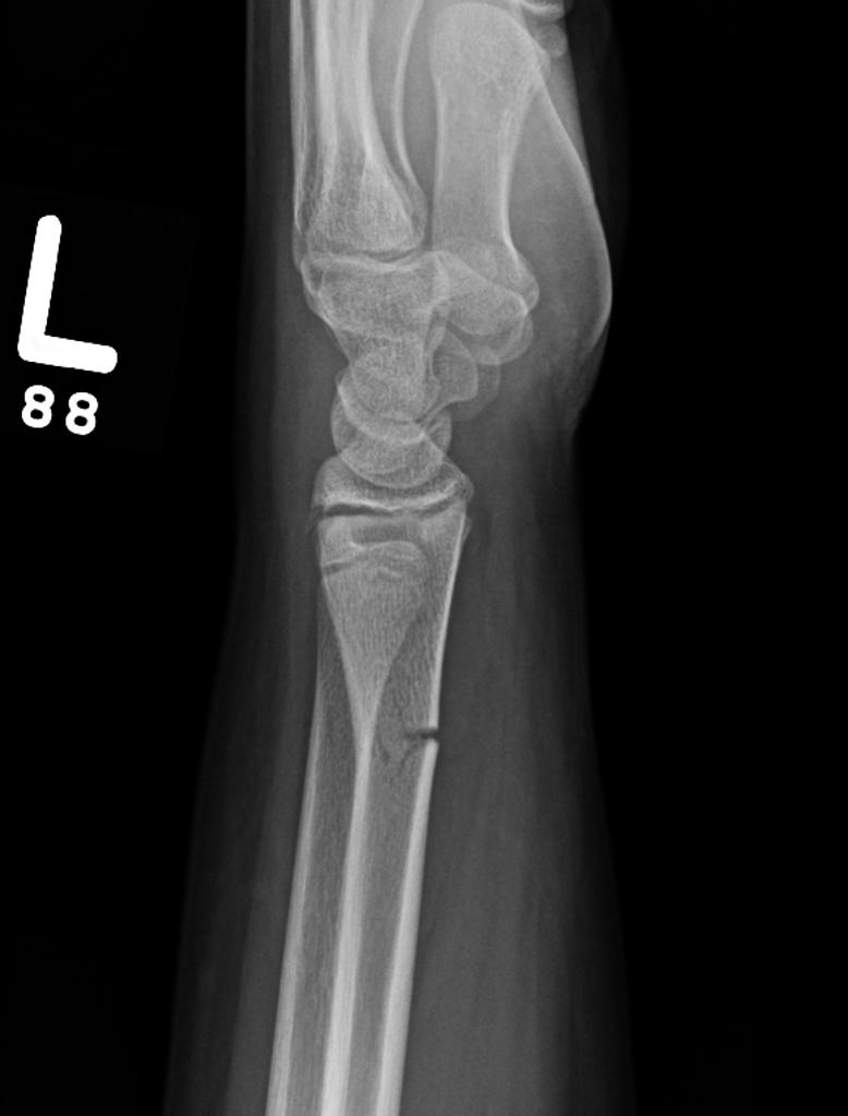 greenstick fracture greenstick fracture